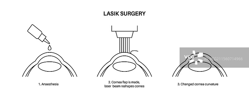 激光矫正视力手术图片素材