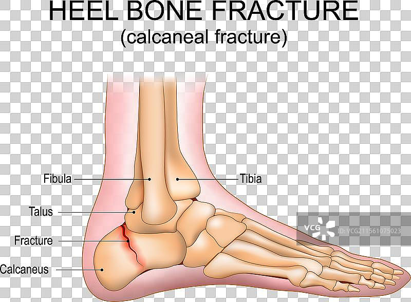 跟骨骨折图片素材