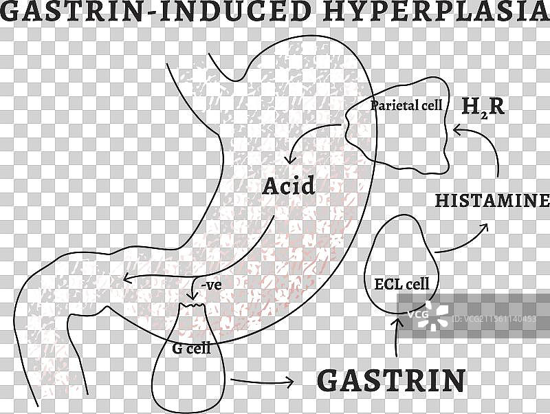 胃酸引起的胃泌素增生图片素材