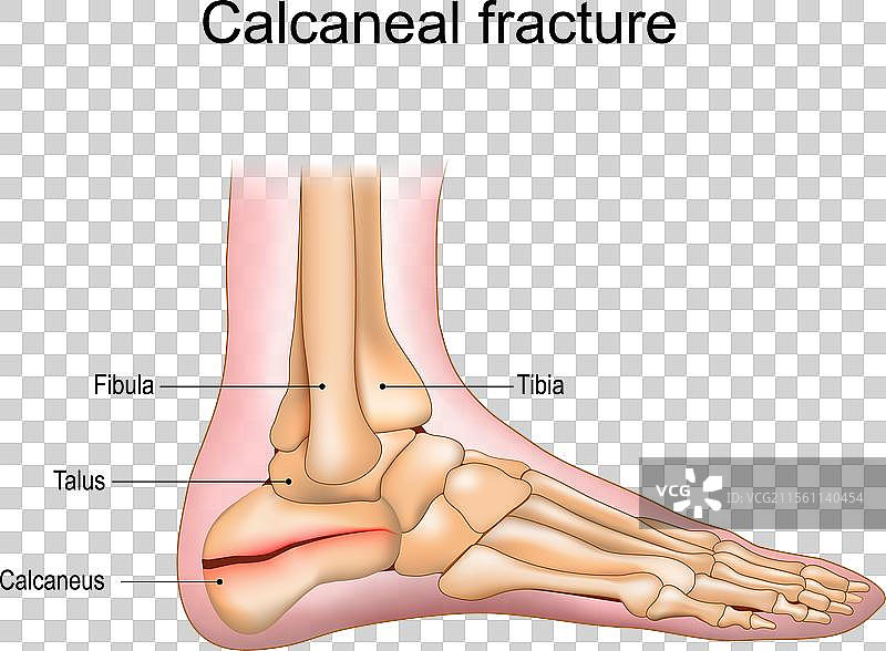 跟骨骨折，脚跟骨的创伤图片素材