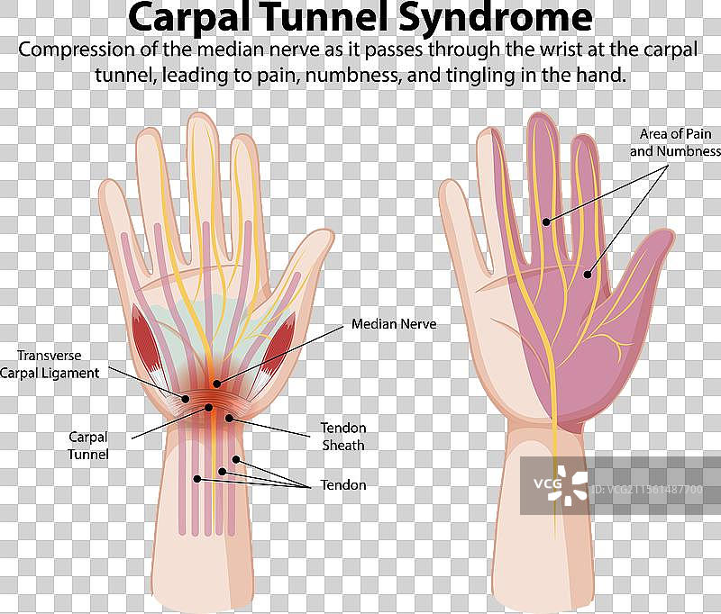 显示腕管综合症症状的图示图片素材