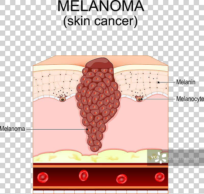 黑色素瘤皮肤癌图片素材
