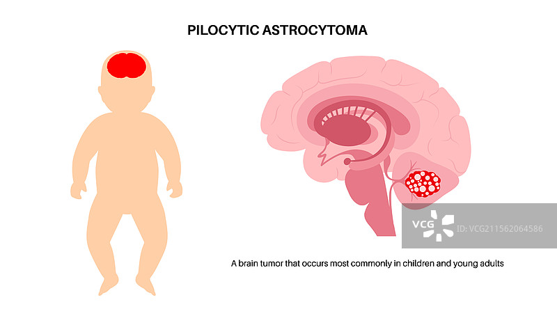毛细胞星形胶质瘤海报图片素材