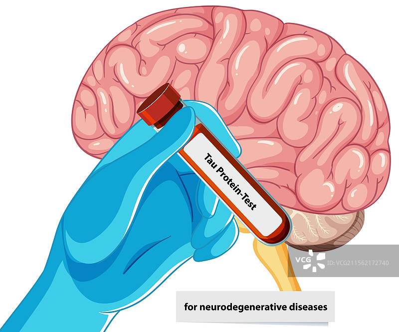 神经退行性疾病的tau蛋白检测图片素材