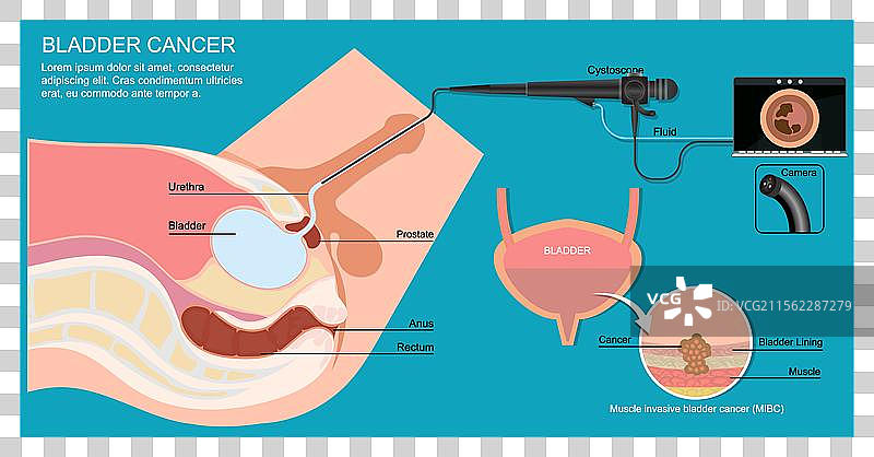 膀胱镜检查可以观察尿道内部和图片素材