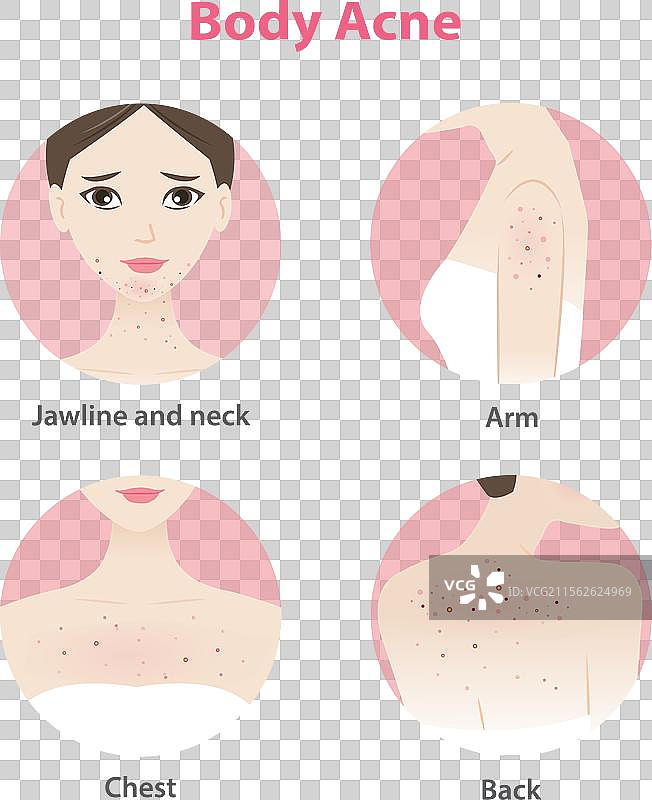 女性面部和身体痤疮图标集图片素材