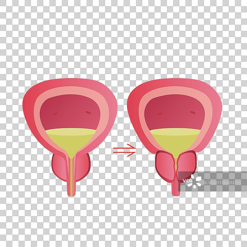 前例腺男科泌尿外科世界男性健康日关注男性健康前例腺炎前列腺增生前列腺癌图片素材