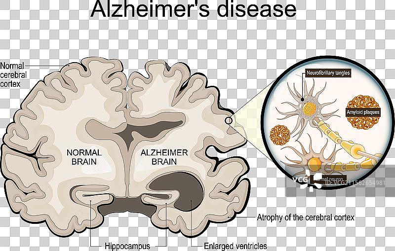 阿尔茨海默病海马体特写图片素材
