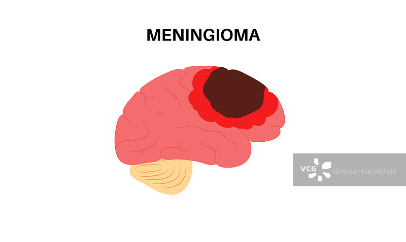 脑膜瘤癌症概念图片素材