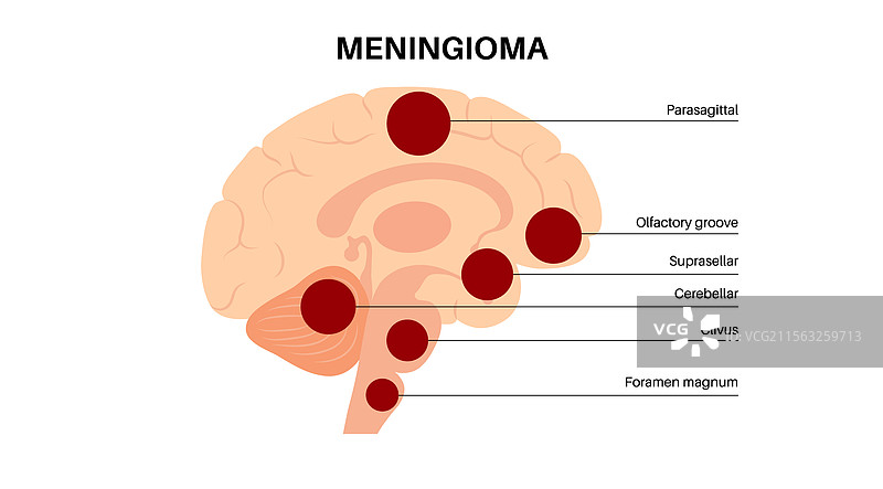 脑膜瘤癌症海报图片素材