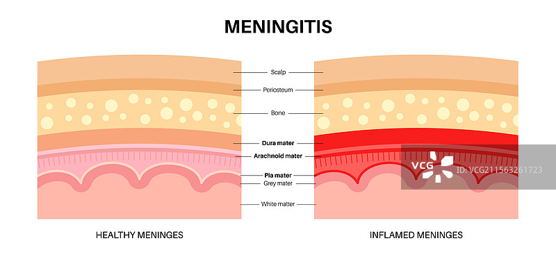 脑膜炎医学海报图片素材