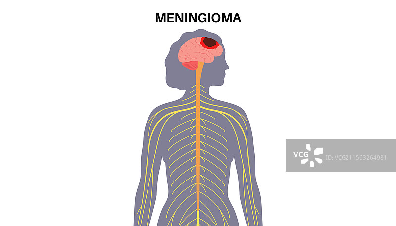 脑膜瘤癌症概念图片素材