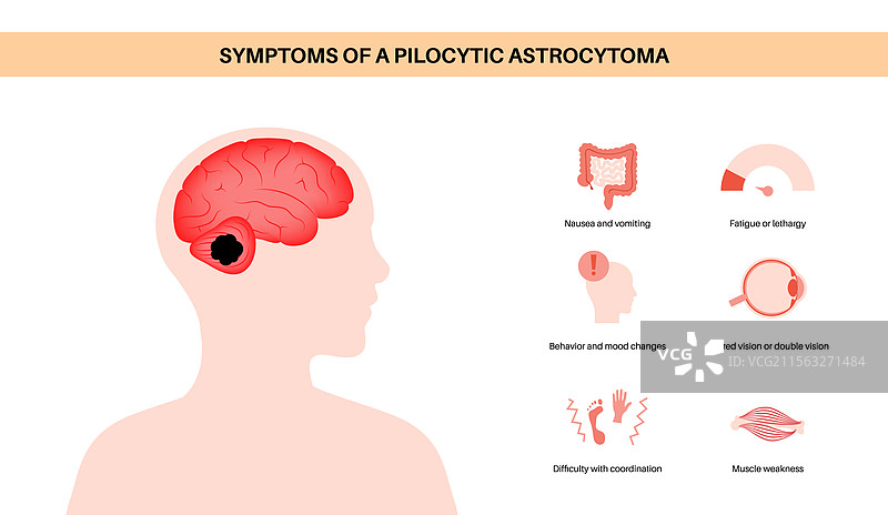 毛细胞星形胶质瘤海报图片素材