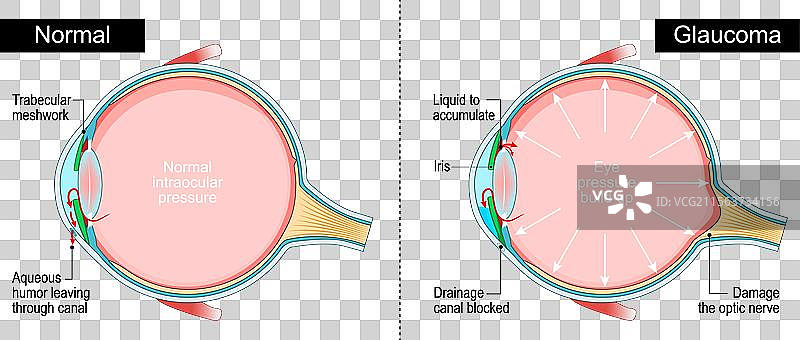 青光眼的人眼横截面图片素材