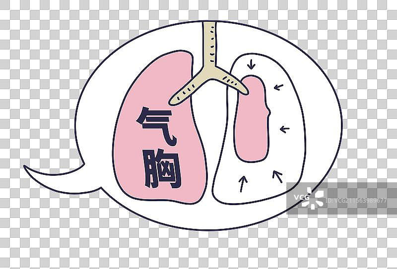 气胸，肺部疾病图片素材