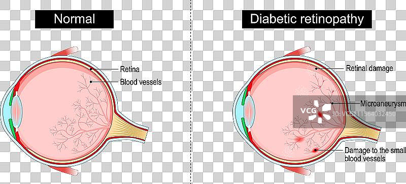 糖尿病视网膜病变图片素材
