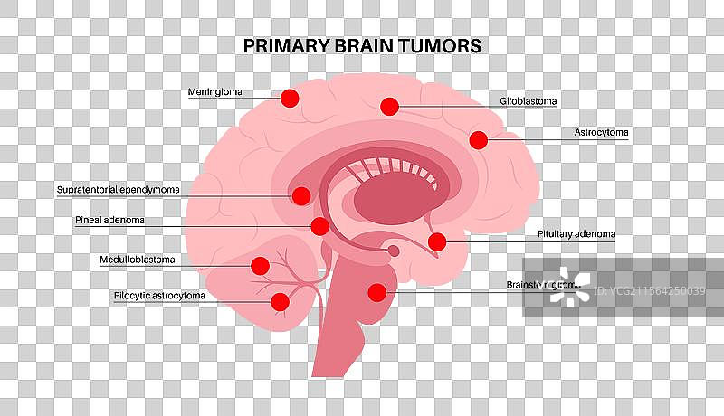 原发性脑肿瘤图片素材