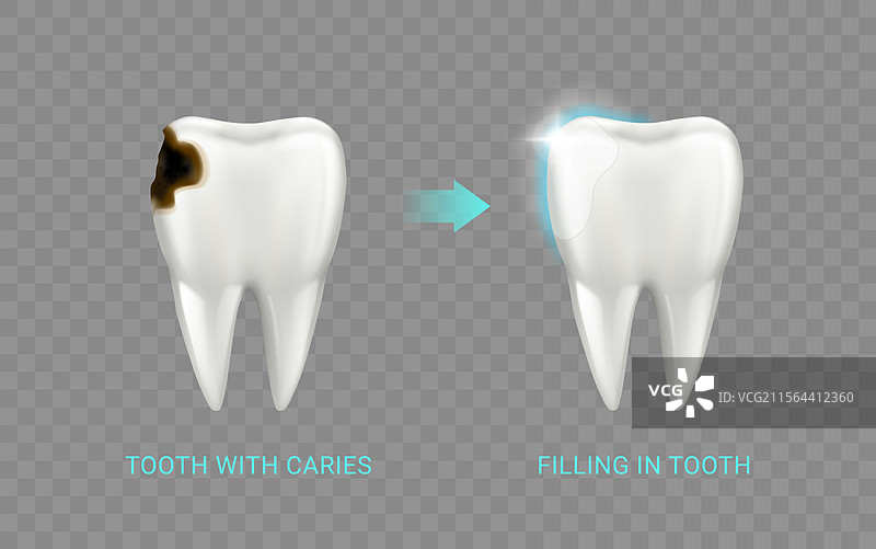 修复有龋齿的牙齿感觉图片素材