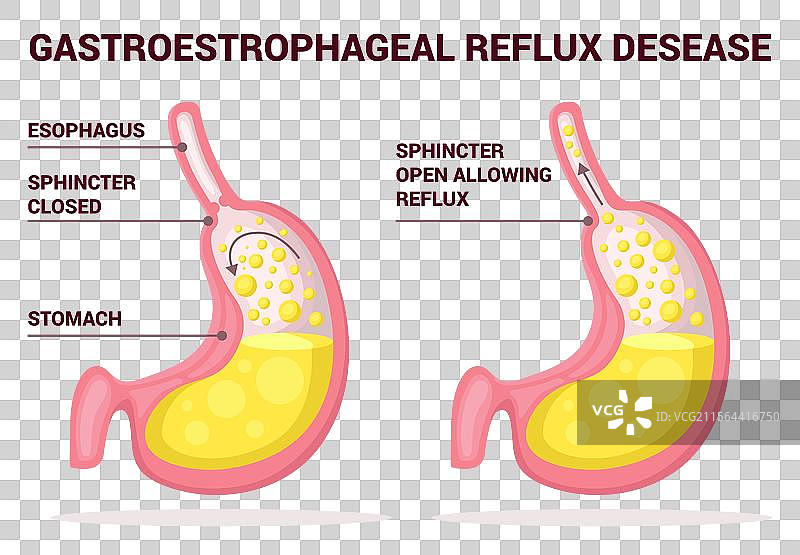 胃食管反流病 酸性反流图片素材