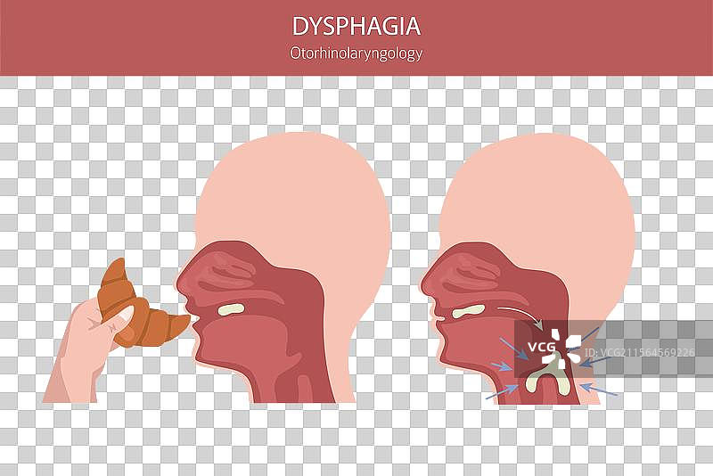 口腔吞咽困难疾病 耳鼻喉科图片素材