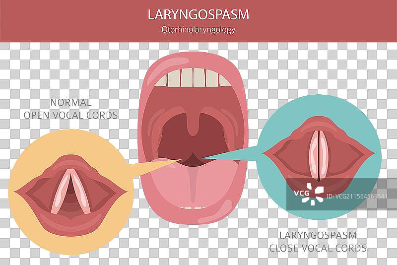 喉痉挛 疾病 耳鼻喉科 声音图片素材