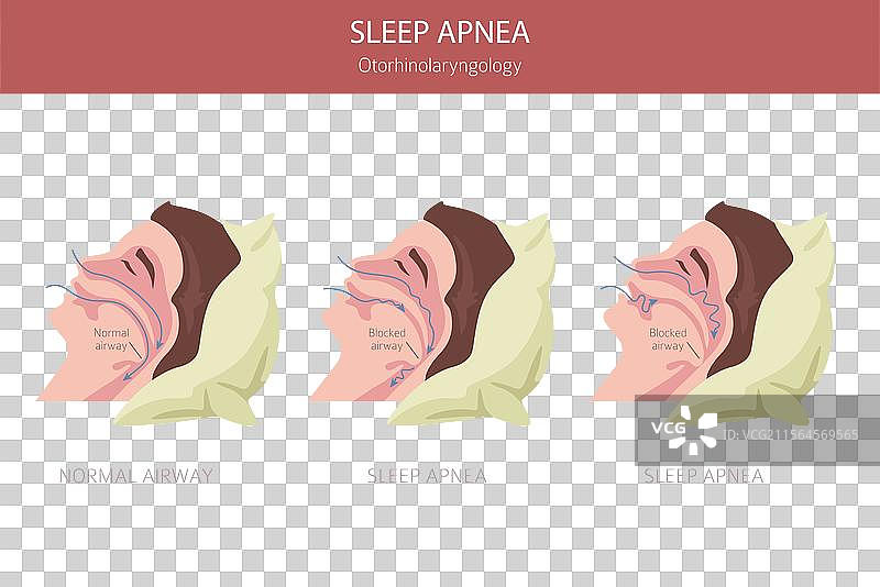 睡眠呼吸暂停疾病 耳鼻喉科 睡眠图片素材