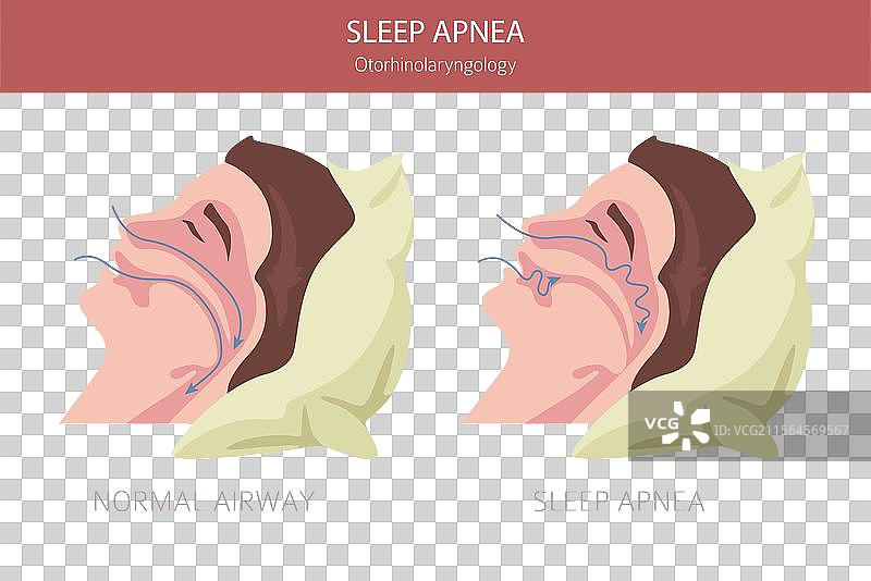 睡眠呼吸暂停疾病 耳鼻喉科 睡眠图片素材