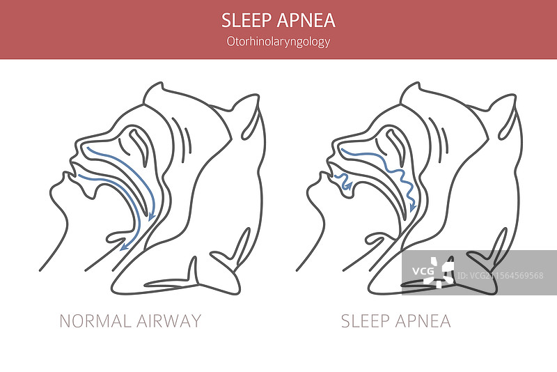 睡眠呼吸暂停疾病 耳鼻喉科 睡眠图片素材
