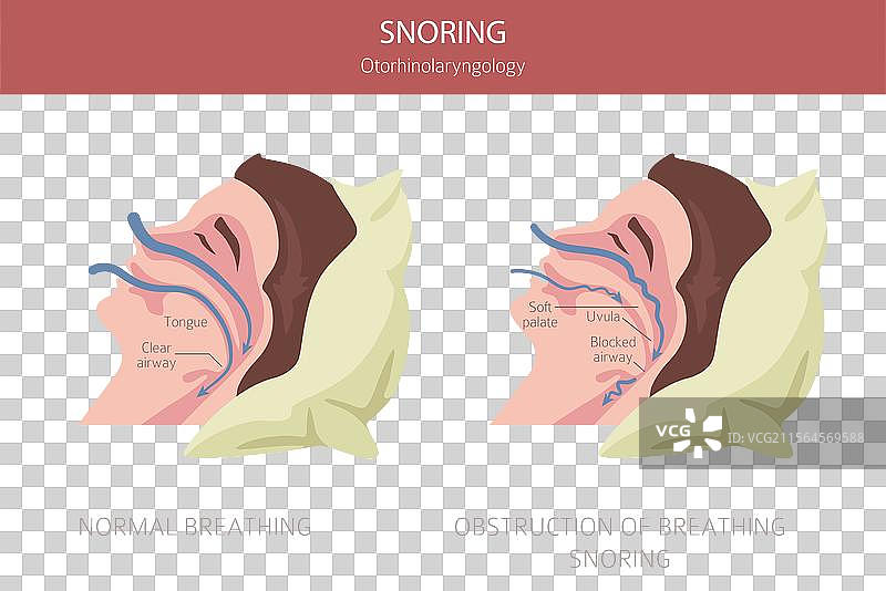 打鼾疾病 阻塞性睡眠呼吸暂停 睡眠图片素材