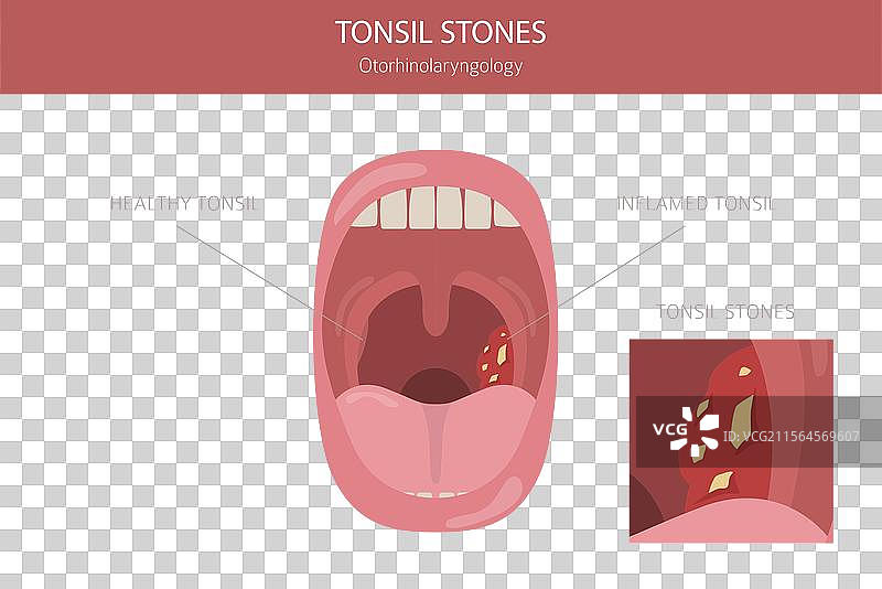 扁桃体结石 疾病 耳鼻喉科图片素材