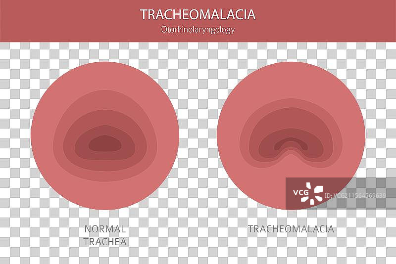 鼻腔息肉 1图片素材