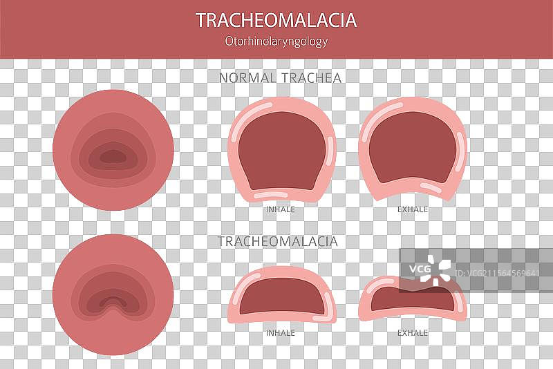 鼻腔息肉 1图片素材