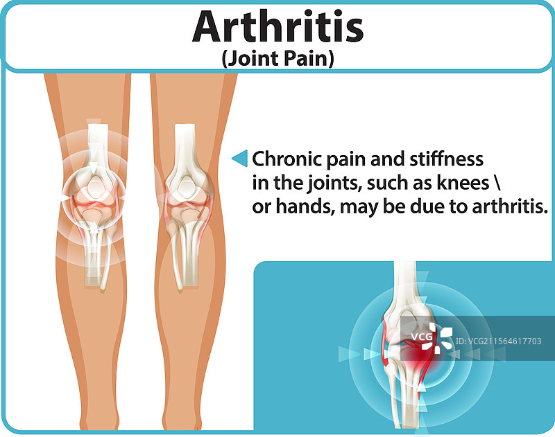 影响膝关节的关节炎图片素材