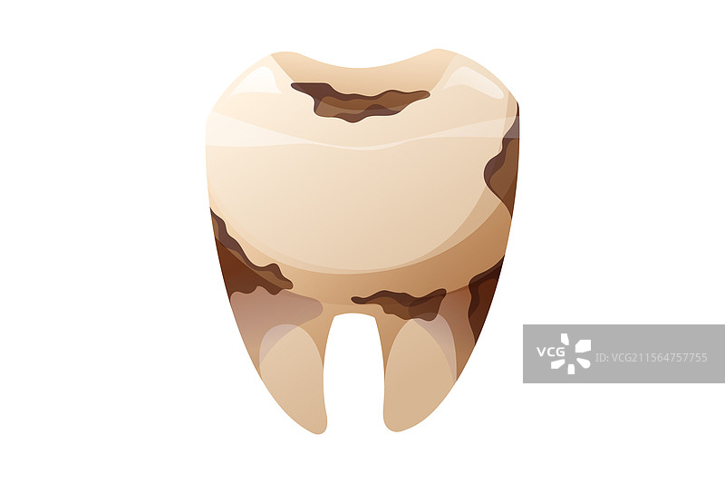 腐烂的牙齿，伴有蛀洞和牙菌斑积聚图片素材