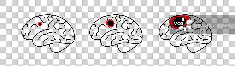 脑癌分级图片素材