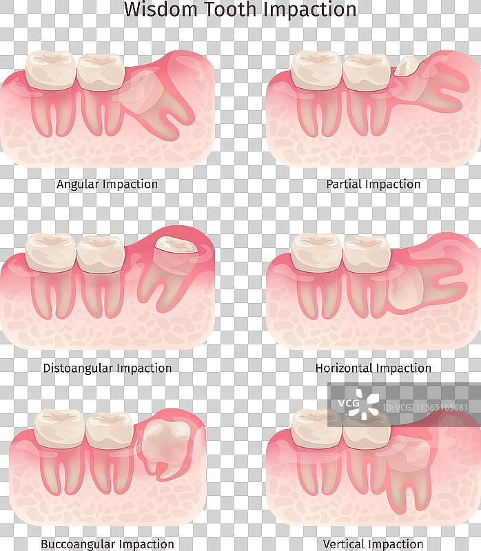 智齿 牙齿问题 臼齿图片素材