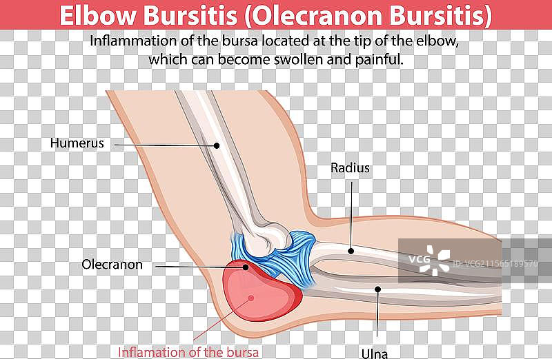 肘部滑囊炎引起的疼痛图片素材