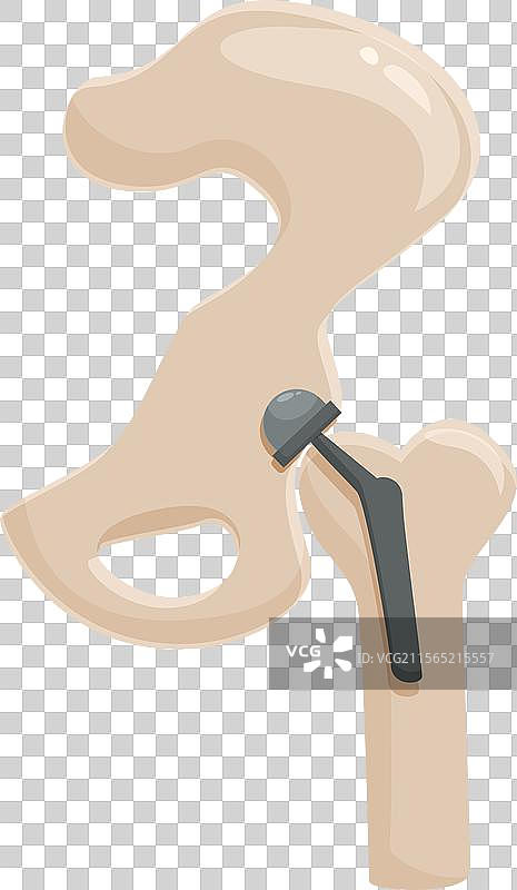 人工髋关节置换图片素材