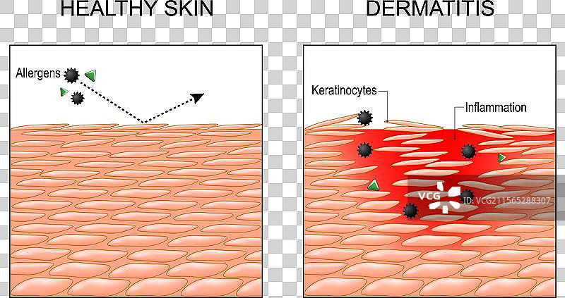 皮肤炎、湿疹、银屑病的横截面图片素材