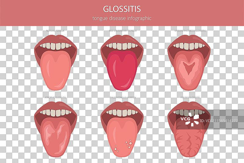 舌炎 舌病 口腔医学 医学图片素材