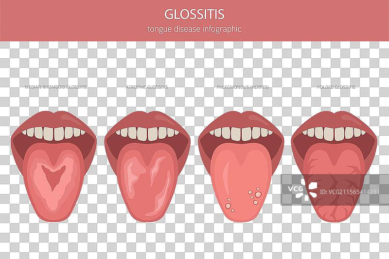 舌炎 舌病 口腔医学 医学图片素材
