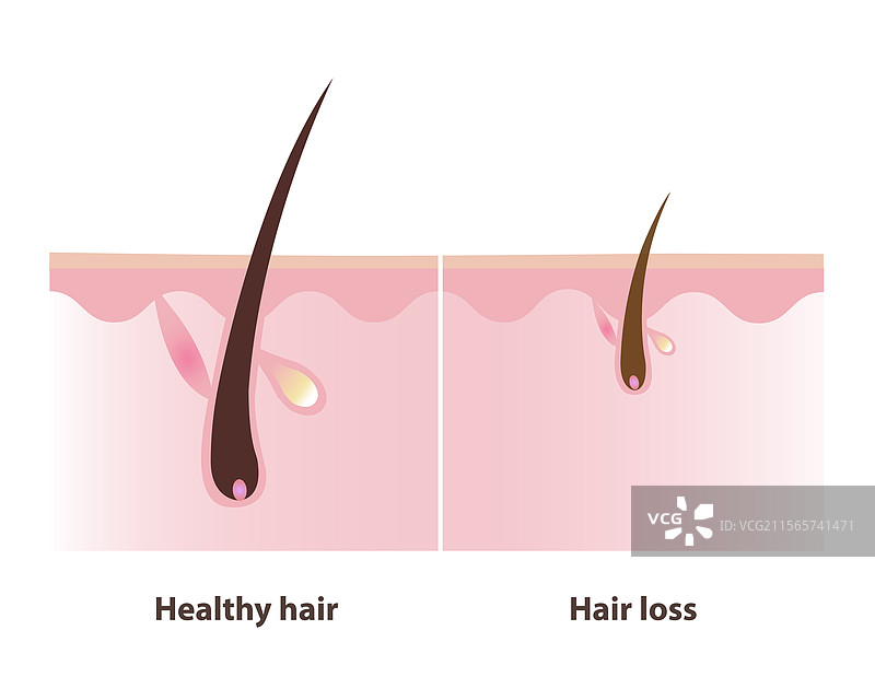 健康的头发和脱发的毛囊图片素材