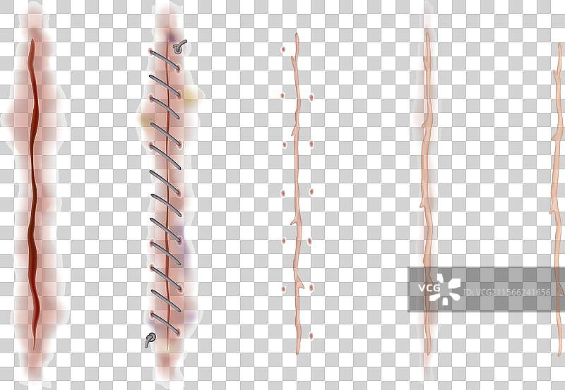 一组愈合伤口、皮肤伤疤、缝合伤口和裂口图片素材