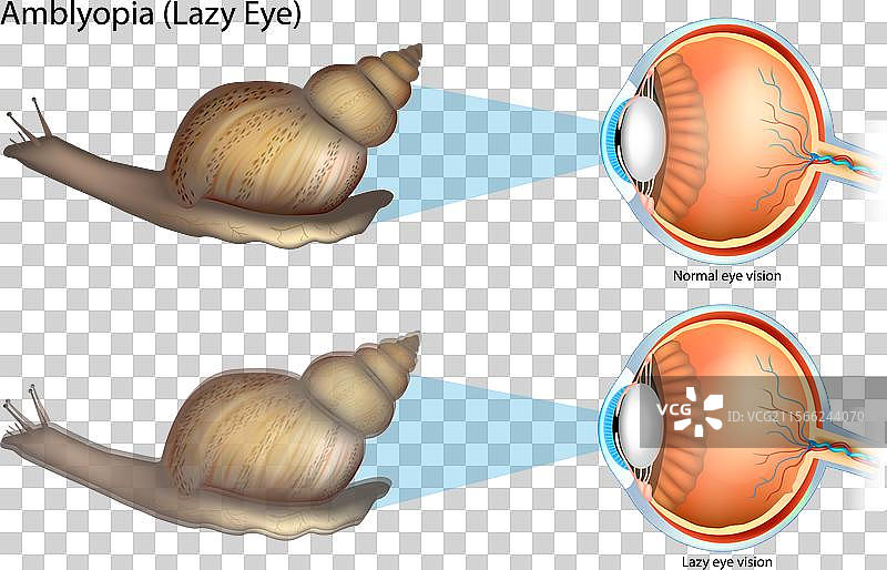 弱视或懒惰眼 懒惰眼视力与正常视力图片素材