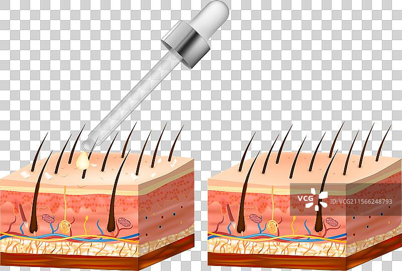 脂溢性皮炎治疗前后的对比图片素材