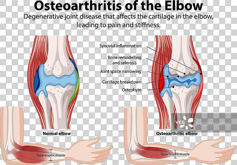 正常肘关节与骨关节炎肘关节的比较图片素材