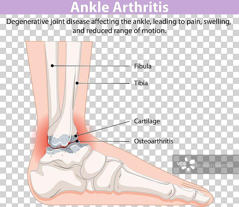 显示踝关节炎及受影响区域的图示图片素材