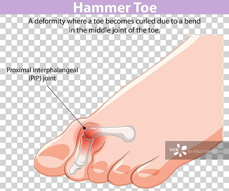 锤状趾畸形和近端指关节的描绘图片素材