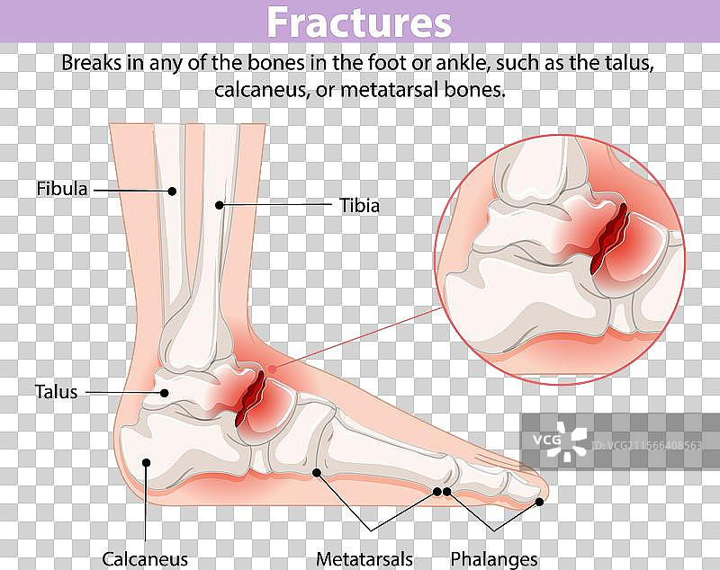 足部和踝部骨折图片素材