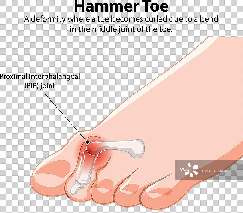 显示锤状趾畸形和PIP关节的图解图片素材